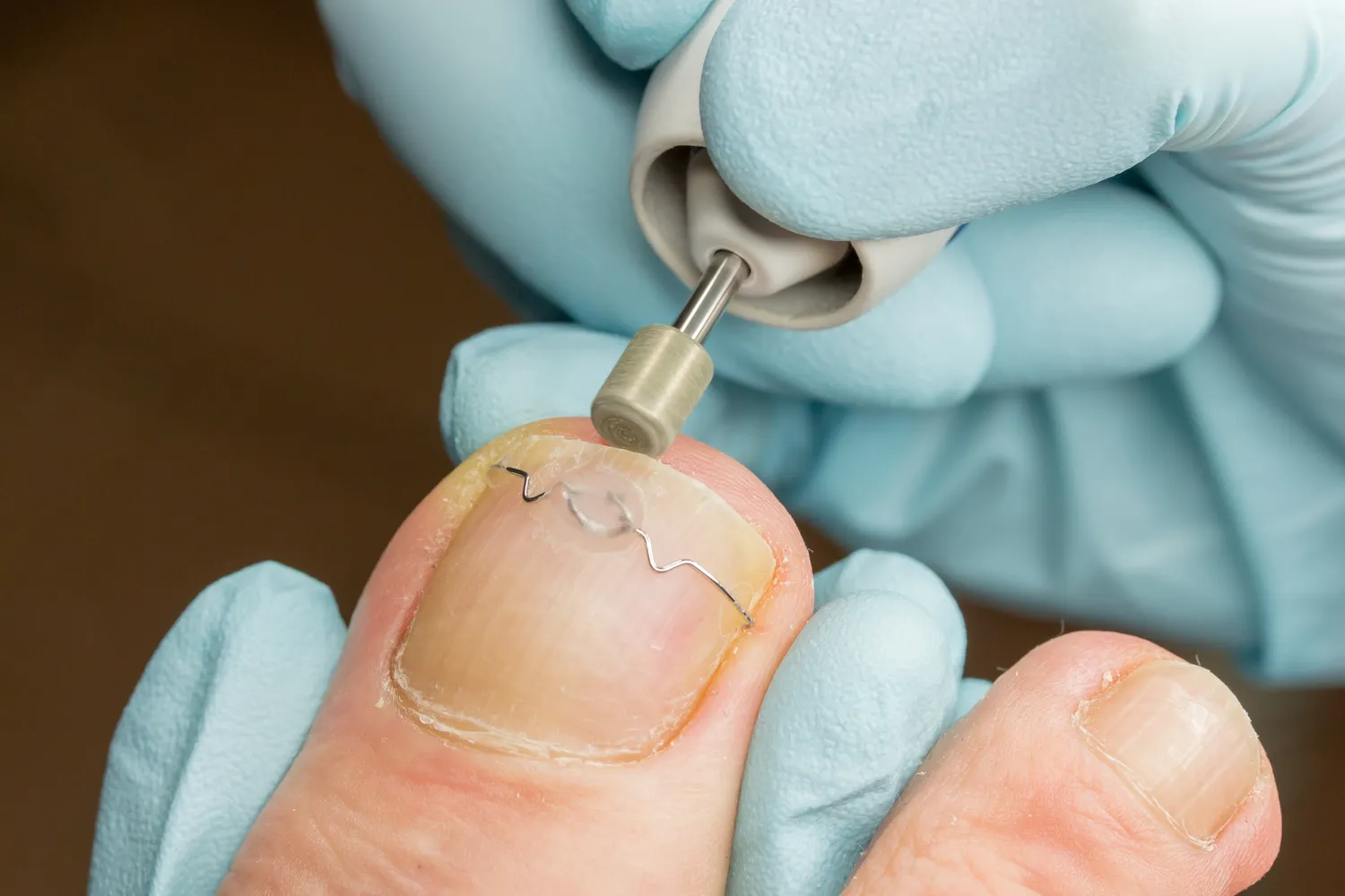 Wrastające paznokcie Warszawa