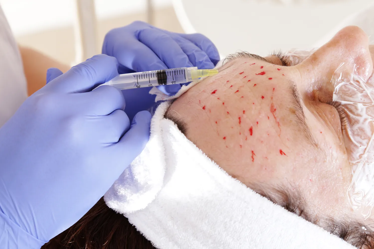 Ile kosztuje kwas hialuronowy?