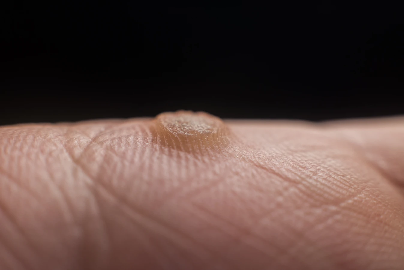 Kurzajki podolog czy dermatolog?
